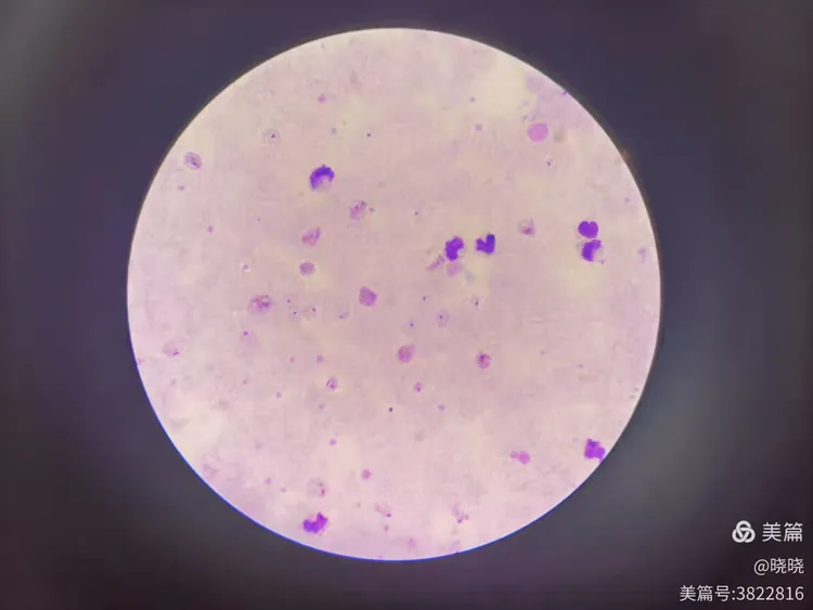 三种疟原虫厚膜染色法对比